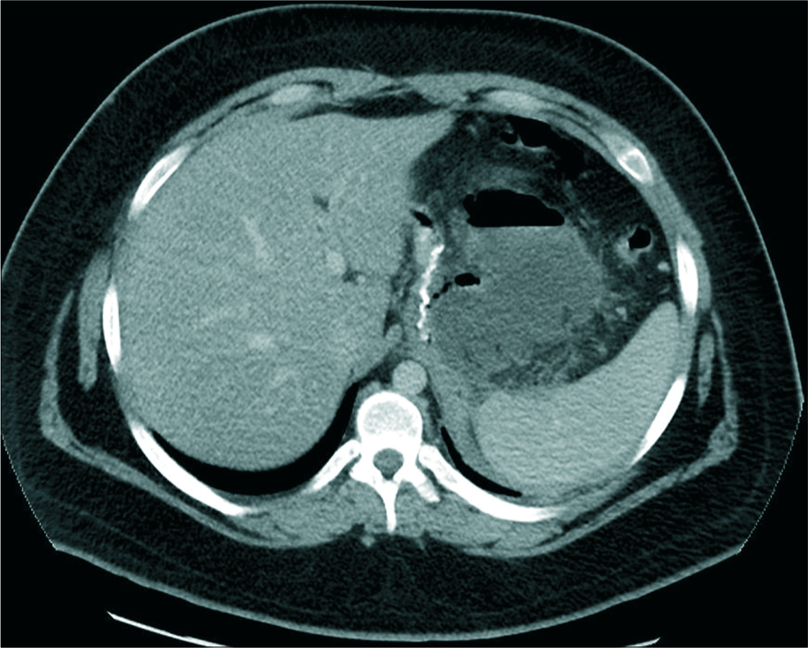 A 19-year-old male patient presented with fever, enhanced axial computed tomography scan image showing perigastric collection without oral contrast leak with a gas fluid level and enhancing wall.