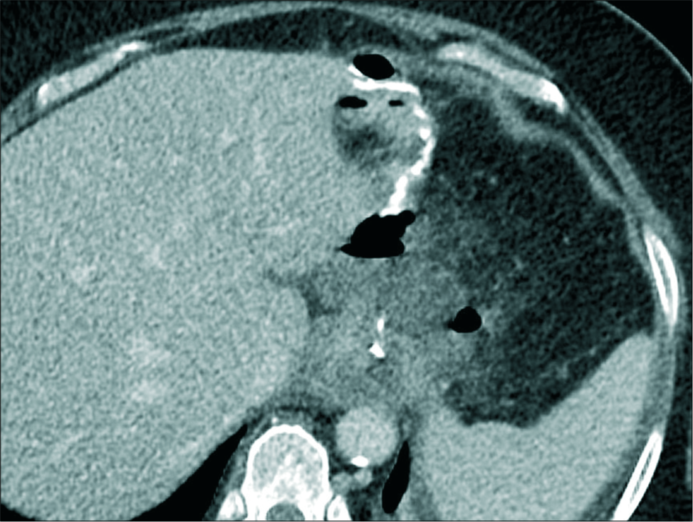 A 60-year-old male patient presented with repeated vomiting, an enhanced axial computed tomography image showing perigastric fluid collection associated with fat stranding and a small pocket of air but no enhancing peripheral wall.