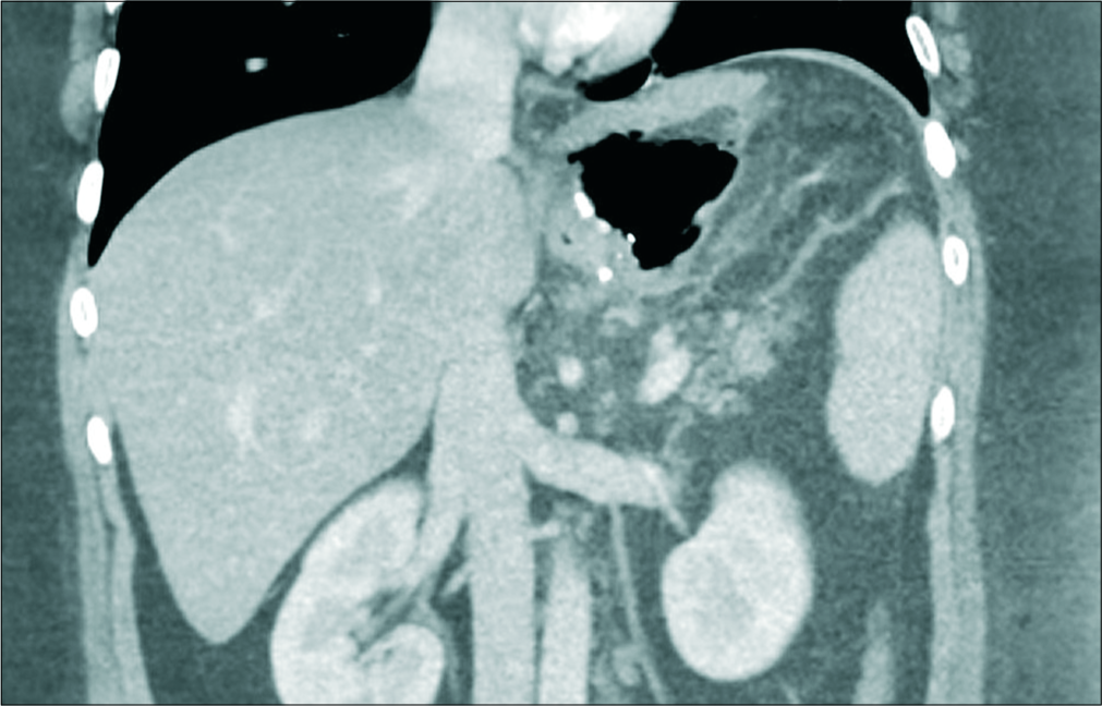 A 30-year-old male patient presented with the left shoulder pain and vomiting, enhanced coronal CT image showing extraluminal large gas pocket adjacent to gastric sleeve indicating a gas leak.