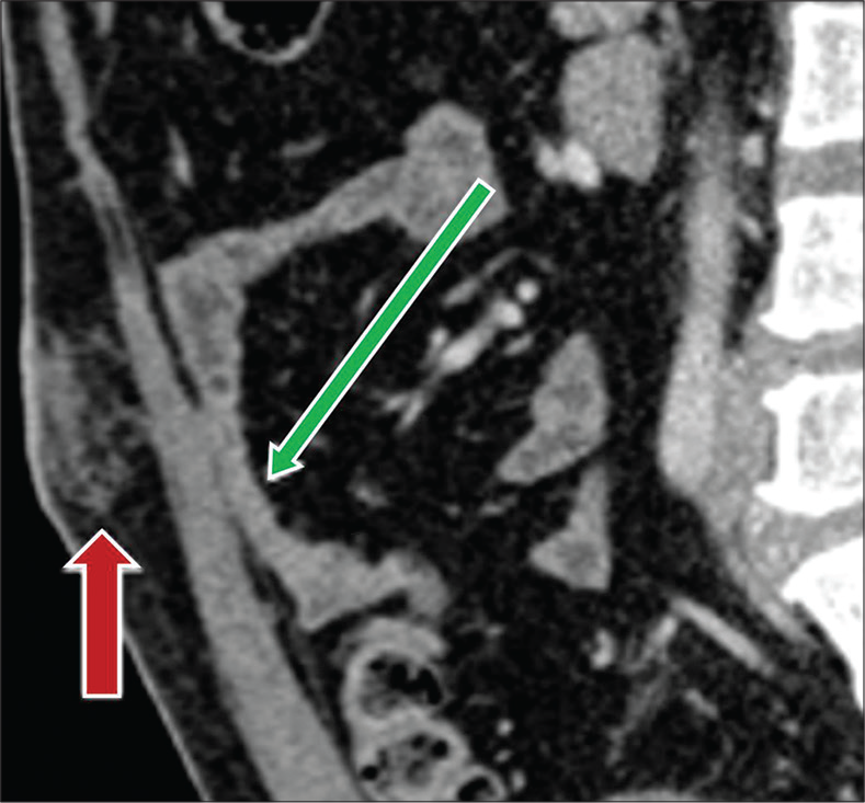 A 52-year-old man with recent history of laparoscopic cholecystectomy, 2 weeks prior presenting with abdominal pain. Sagittal contrast-enhanced CT image demonstrates formation of early bowel adhesions (green arrow). Note postsurgical changes at the umbilicus from laparoscopic port placement (red arrow).