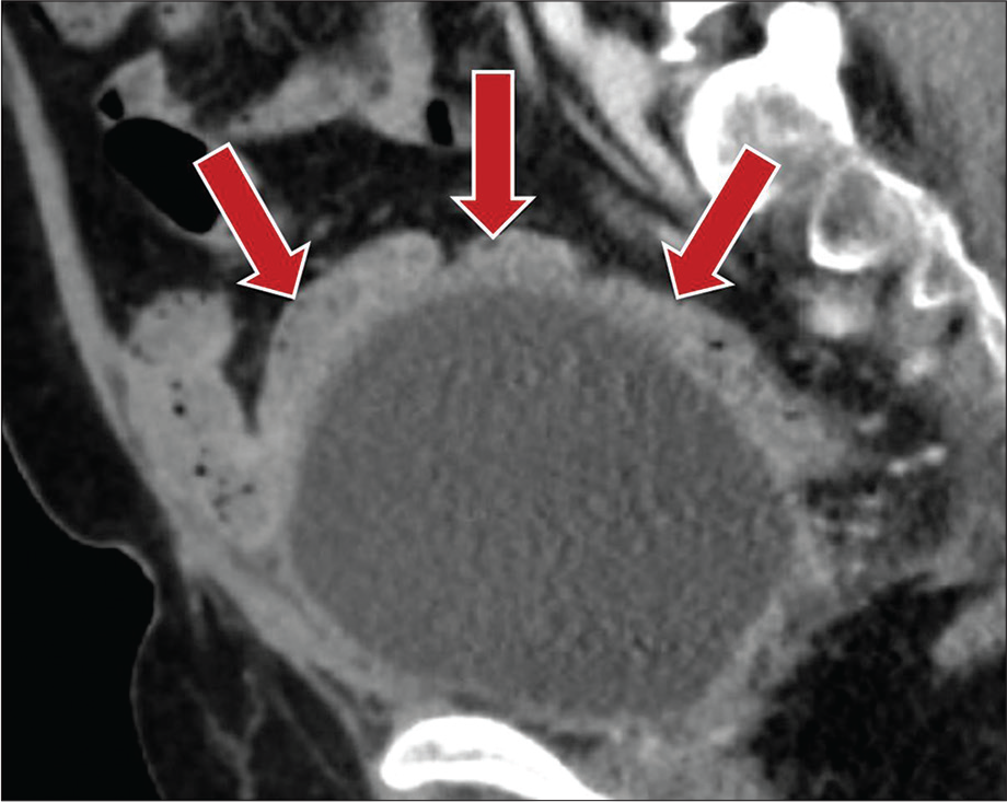 A 50-year-old male status post-prostatectomy presenting with chronic intermittent abdominal pain. Contrast-enhanced sagittal CT image demonstrates enterovisceral adhesions to the bladder dome with matted appearance of small bowel loops (red arrows).