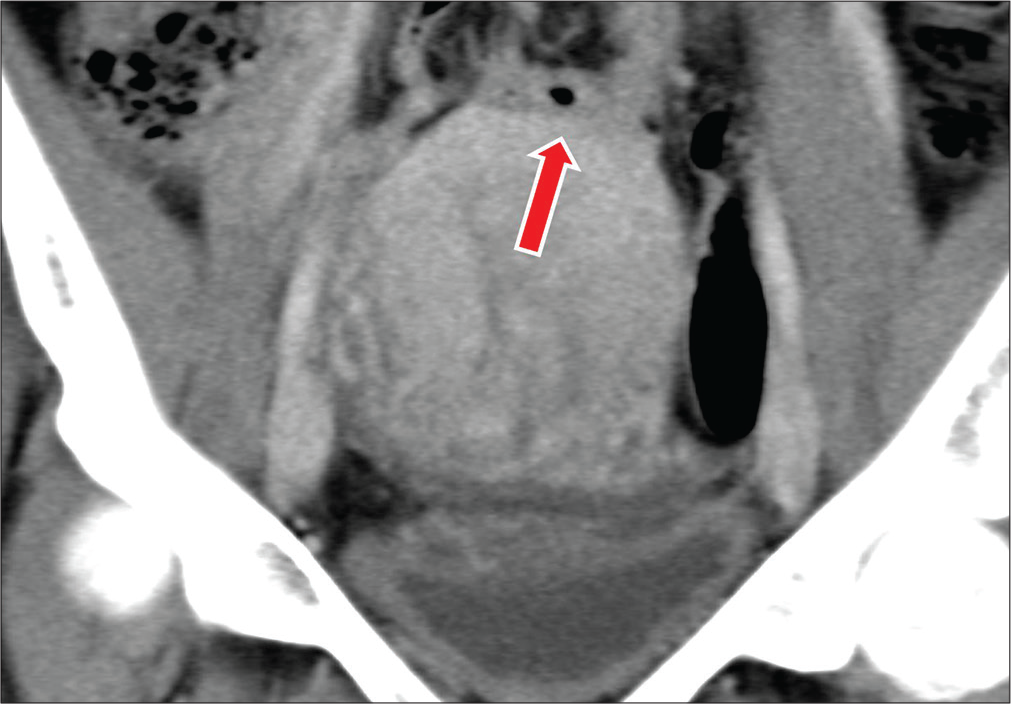 A 28-year-old female with a history of four cesarean section deliveries presents with abdominal pain. Coronal CT image demonstrate a loop of small bowel adherent to the superior aspect of the uterus (red arrow).