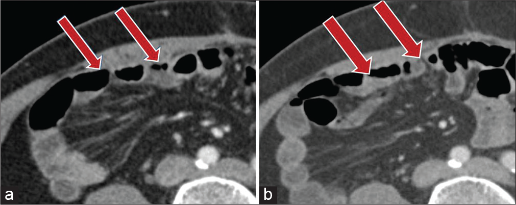 A 53-year-old male with prior history of laparotomy for gastric gastrointestinal stromal tumor, 3 years ago, presenting with sudden onset abdominal pain. (a) Contrast-enhanced axial CT image demonstrates bowel loops abutting the right anterior abdominal wall with obliteration of the right post-rectus fat plane (red arrows). (b) Two-year follow-up contrast-enhanced axial CT shows small bowel loops unchanged in location (red arrows).