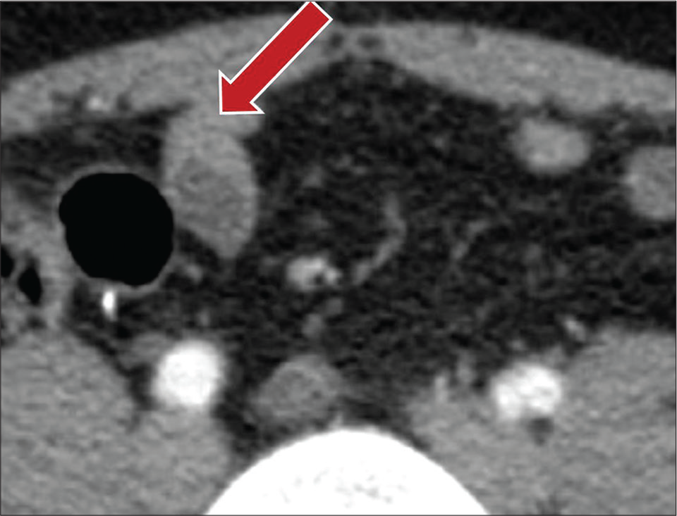 A 73-year-old male with a history of laparotomy for appendiceal carcinoid presenting with abdominal pain. Contrast-enhanced axial CT images show small bowel loop with asymmetric wall thickening from underlying adhesions (red arrow).