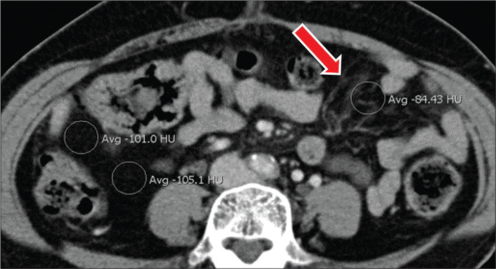 A 44-year-old female status post-cholecystectomy presents with abdominal pain. Axial contrast-enhanced CT images show localized increase in mesenteric attenuation in the left abdomen when compared to normal mesenteric fat in the right abdomen, related to mesenteric congestion (red arrow) secondary to underlying adhesions.