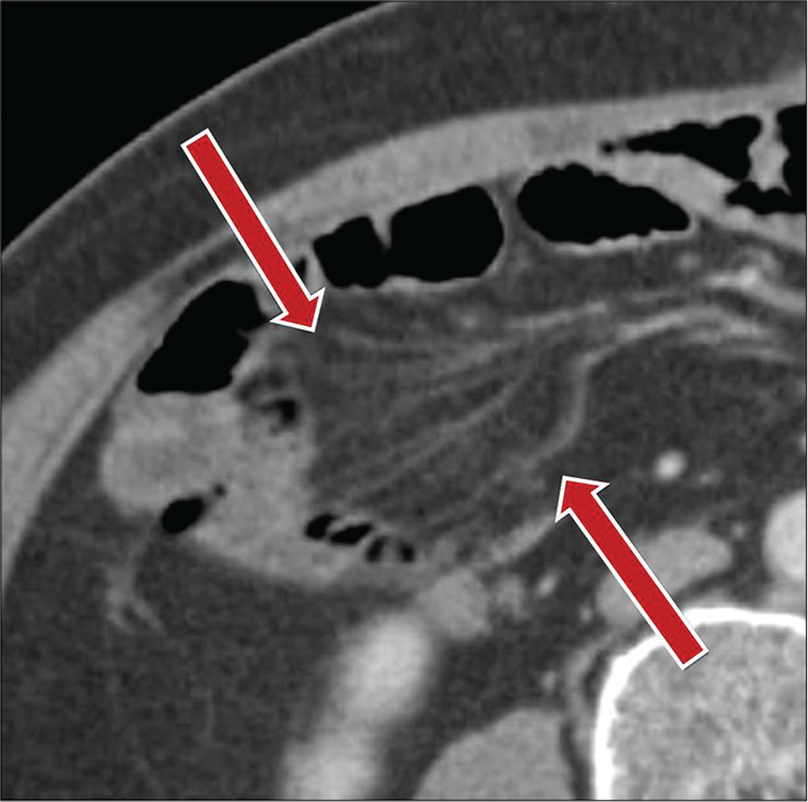 A 56-year-old male with a history of cholecystectomy presenting with abdominal pain. Axial contrast-enhanced CT image demonstrating localized vascular crowding in the right abdomen related to mesenteric congestion (red arrows) secondary to underlying small bowel adhesions.