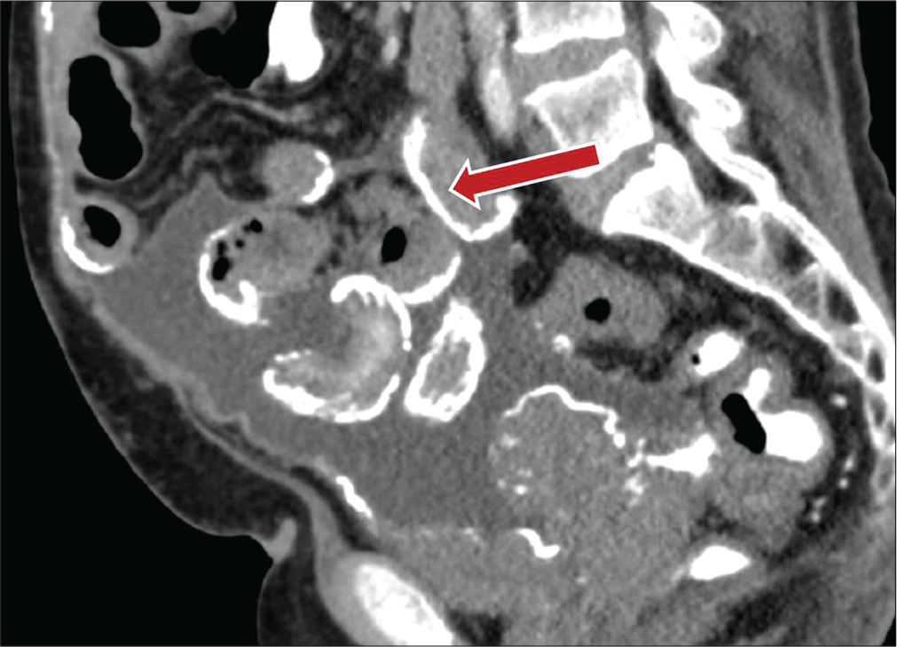 A 73-year-old male with a history of peritoneal dialysis presenting with abdominal pain. Sagittal contrast-enhanced CT image demonstrates thick peritoneal and mesenteric surface calcifications (red arrow) involving multiple loops of bowel, consistent with encapsulating peritoneal sclerosis.