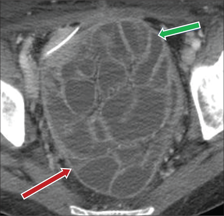 A 56-year-old male, status post-colonic surgery, presents with abdominal pain and vomiting. Axial CT image demonstrates a cluster of adherent fluid filled mildly dilated small bowel loops in pelvic region (green arrow), enclosed by thickened peritoneal lining (red arrow), consistent with “cocoon abdomen.”