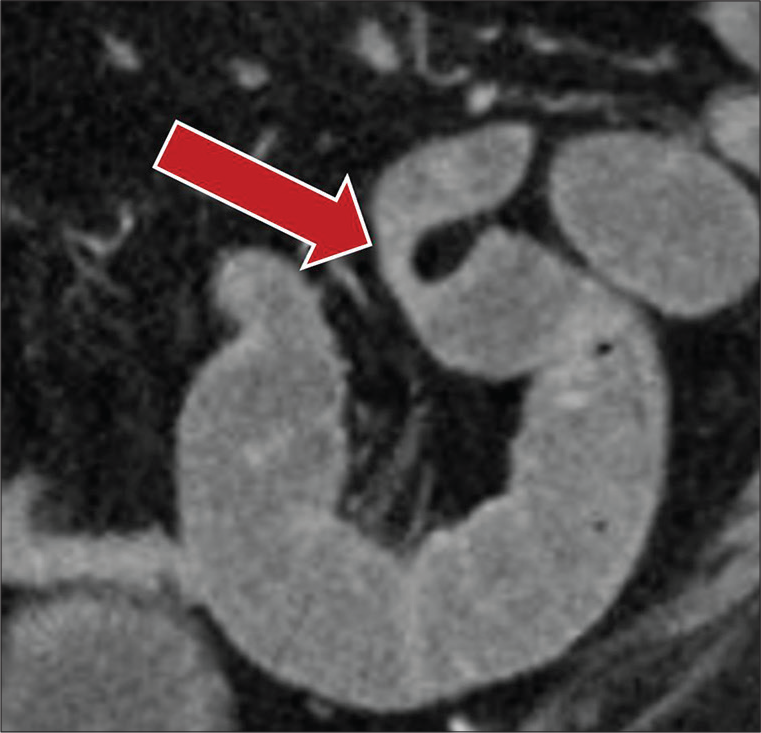 A 44-year-old female with a surgical history of hysterectomy presenting with abdominal pain, nausea, and vomiting. Coronal CT image demonstrates the fat notch sign (red arrow), secondary to mesenteric fat insinuating between bowel loops secondary to underlying adhesions.