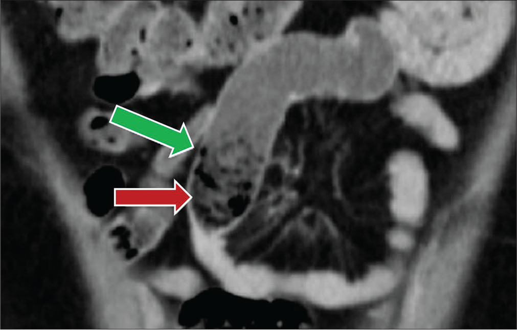 A 47-year-old female status post-hysterectomy presenting with nausea. Coronal contrast-enhanced CT image demonstrates the “beak” sign or focal caliber change of a small bowel loop in the mid abdomen (red arrow) with fecalized material “small bowel feces sign” present proximal to the caliber change (green arrow).