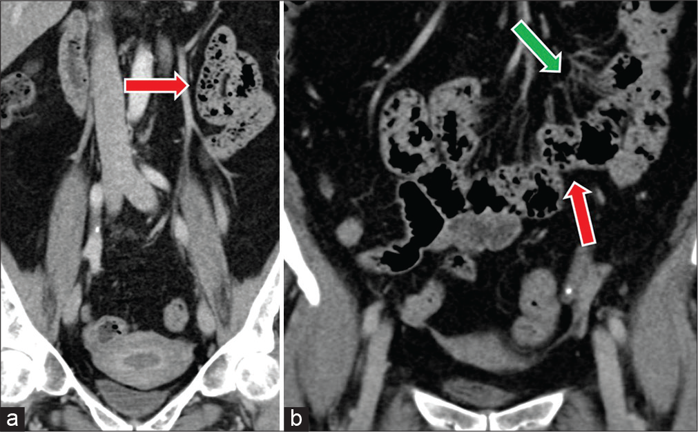 (a and b) A 69-year-old female with a history of tubal ligation presents with abdominal pain. Coronal CT images demonstrate non-distended small bowel loops clustered in the mid-abdomen containing fecalized material consistent with small bowel feces sign (red arrows). Note is made of regional mesenteric congestion (green arrow).
