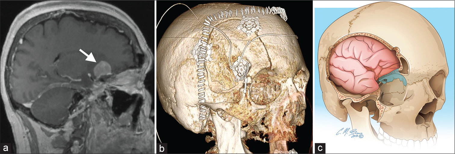 A 55-year-old woman with the right paraclinoid meningioma (a – arrow) on sagittal T1 magnetic resonance imaging. Three-dimensional volume rendering (b) demonstrates post-operative orbitozygomatic craniotomy, the preferred approach for orbital apex, paraclinoid, cavernous sinus, basal cistern, or upper clivus lesions. An orbital rim fracture (c – blue highlight) should be avoided, as it can result in an optic nerve injury.