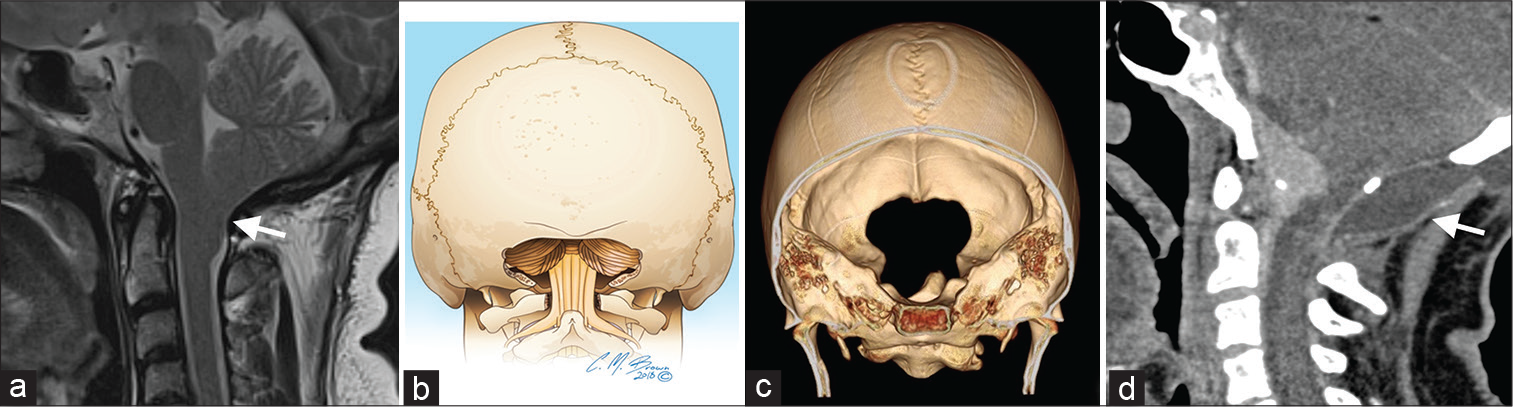 A 45-year-old woman with Chiari I malformation (a – arrow) on axial and sagittal T2W magnetic resonance imaging. Coronal view illustration (b) and three-dimensional volume rendering (c) demonstrating suboccipital craniectomy, the gold standard for Chiari I malformations. Post-operative imaging may show pseudomeningocele (d – arrow), as seen in this sagittal view CT for a 61-year-old female with a craniocervical meningioma who underwent modified suboccipital craniotomy. This patient was treated with a ventriculoperitoneal shunt to manage the pseudomeningocele and hydrocephalus.