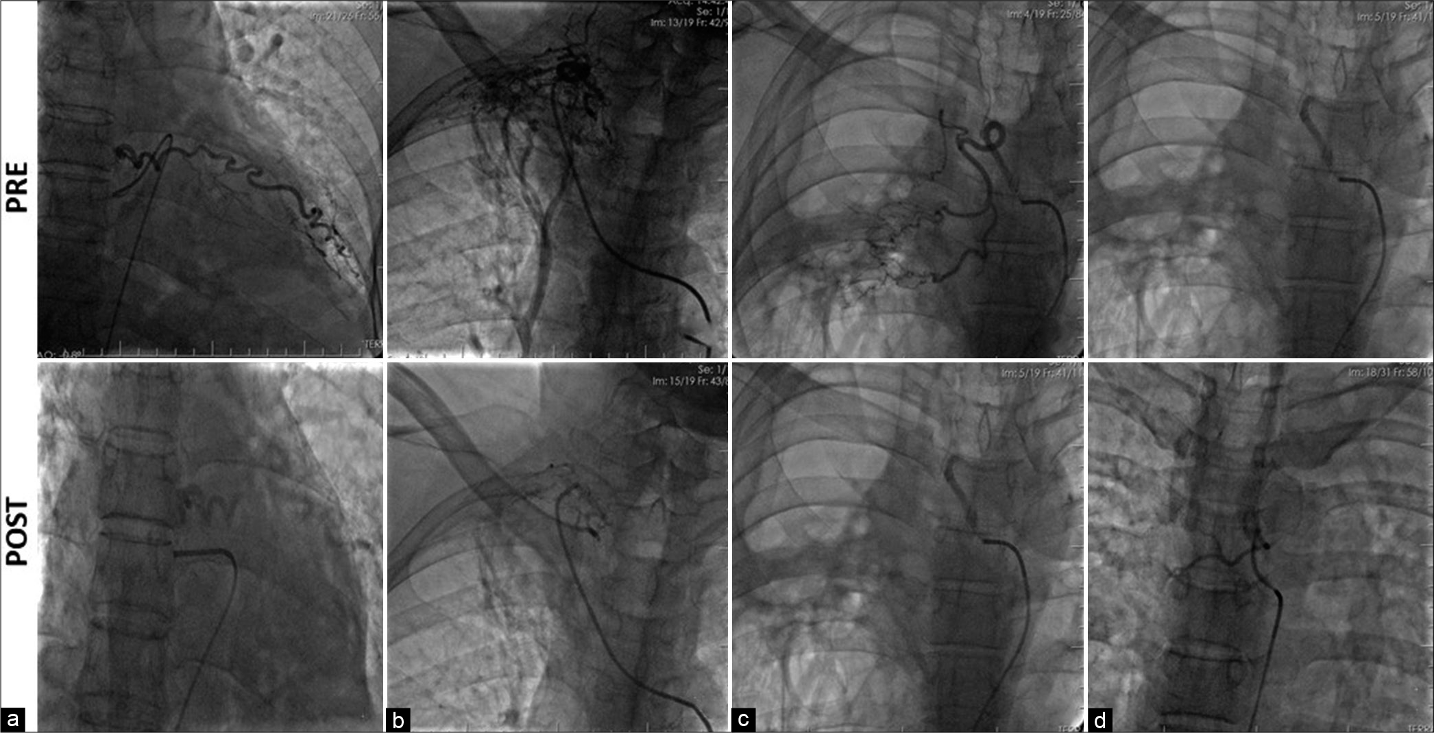 (a-d) Selective bronchial artery angiograms showing a dilated right bronchial artery with abnormal hypervascularity and tortuosity.