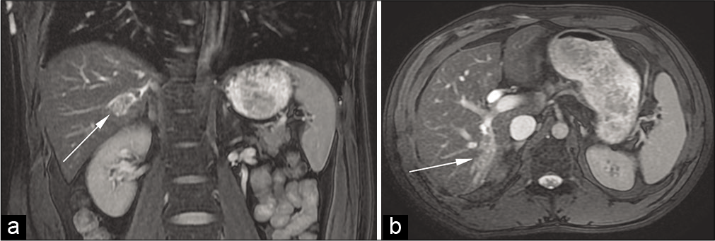 A 37-year-old man with a remote history of a liver laceration presented with the right upper quadrant abdominal pain, nausea, and vomiting. Coronal (a) and axial (b) fluid-sensitive MR images demonstrate bile duct dilatation in the right lobe of the liver (arrows).