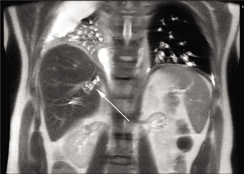 A 45-year-old man with recurrent right upper quadrant abdominal pain. Coronal magnetic resonance cholangiopancreatography demonstrates retained intrahepatic stones (arrow) in the right posterior liver.