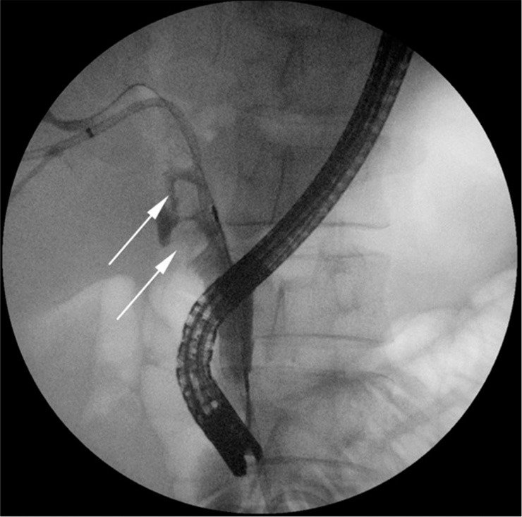 A 45-year-old man with recurrent ascending cholangitis. Endoscopic retrograde cholangiopancreatography demonstrates multiple filling defects in the common bile duct (arrows), but the isolated segment of intrahepatic stones could not be localized.