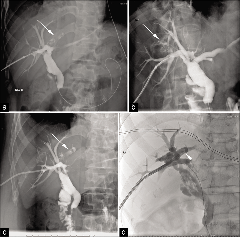 A 45-year-old man with recurrent ascending cholangitis secondary to intrahepatic biliary stones that were not identified at endoscopic retrograde cholangiopancreatography. Intraprocedural fluoroscopic cholangiogram (a-d) demonstrates intrahepatic biliary stones (arrows). A flexible ureteroscope (arrowhead in d) is seen entering into the right hepatic duct.