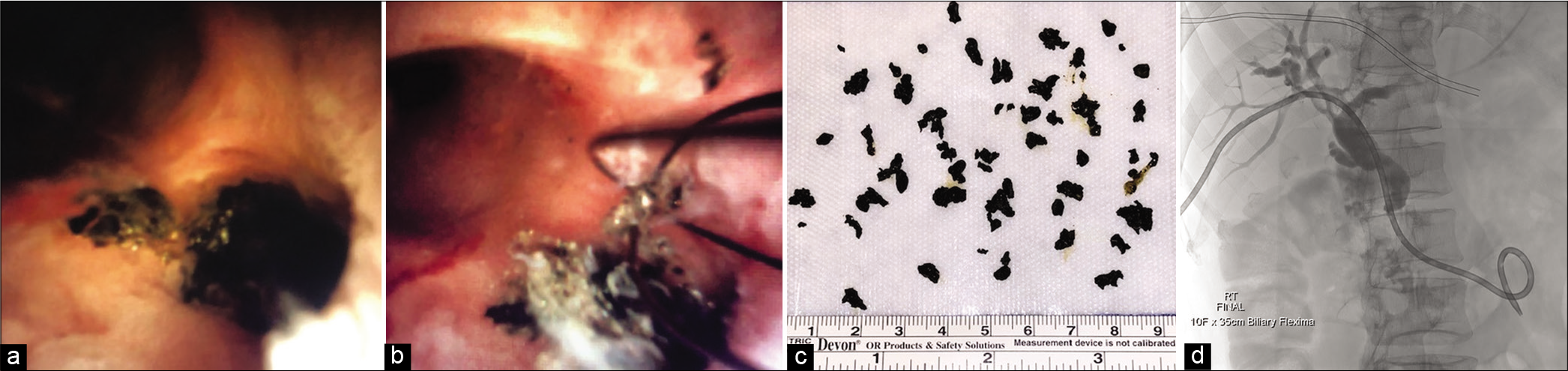 A 45-year-old man with recurrent ascending cholangitis secondary to intrahepatic biliary stones that were not identified at endoscopic retrograde cholangiopancreatography. Endoscopic images reveal the impacted biliary stones (a), with subsequent percutaneous extraction of the stones (b and c). Percutaneous cholangiogram after stone retrieval (d) demonstrates clearing of the filling defects.