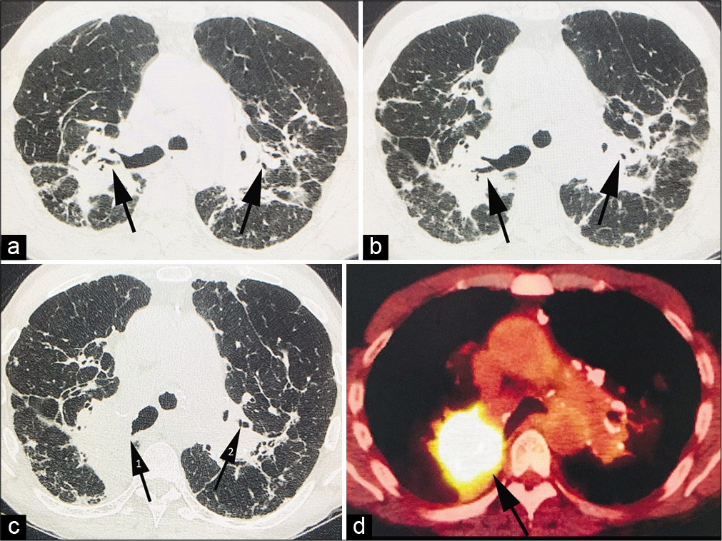 A 62-year-old male who presented with increasing fatigue and breathlessness on a background history of chronic fibrotic pulmonary sarcoid and emphysema. (a) Non-contrast computed tomography (CT) thorax in 2014 showing bilateral conglomerate fibrotic masses (CFMs) on a background of chronic fibrotic sarcoid. Note the patent airways (arrows) within the masses bilaterally. (b) Non-contrast CT thorax in 2016 showing an interval increase in size of the bilateral CFMs. Again, note patent airways (arrows) with the masses. (c) Non-contrast CT thorax in 2019 shows a marked increase in the size of the right conglomerate fibrotic mass. Note obliteration of the airways (arrow 1) within the right conglomerate mass but patent airways in the left conglomerate fibrotic mass (arrow 2). (d) PET-CT thorax with FDG shows intense FDG uptake within the right conglomerate fibrotic mass (arrow) suspicious for an occult malignancy. Subsequent biopsy revealed squamous cell carcinoma.