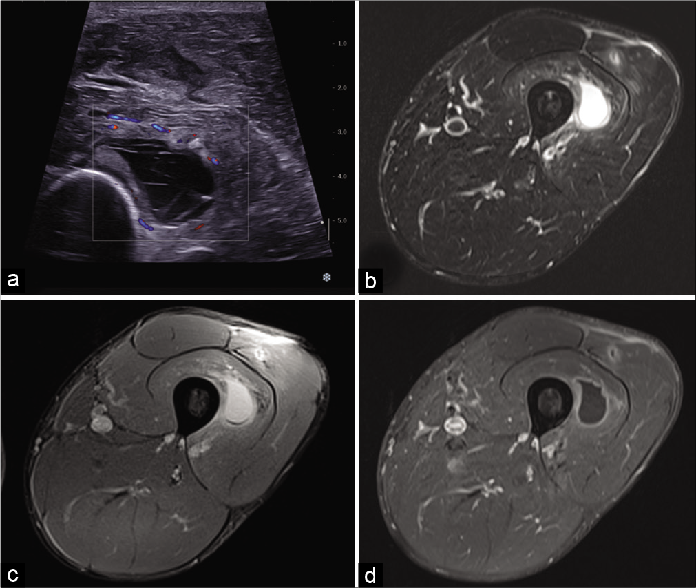 A 32-year-old man with persistent pain in the left thigh 2 weeks after mild anterior trauma. US: Axial ultrasound image shows an anechoic collection with internal septa located in the vastus intermedius muscle (a). On MRI, the hematoma is well-defined, has a high-signal, and is surrounded by edema on fat-suppressed T2-weighted image (b), presents a low-signal deposit on gradient-echo T2-weighted image (c), and thin peripheral enhancement after injection of gadolinium chelates (d). A small post-traumatic lesion is also visible in the vastus lateralis muscle.