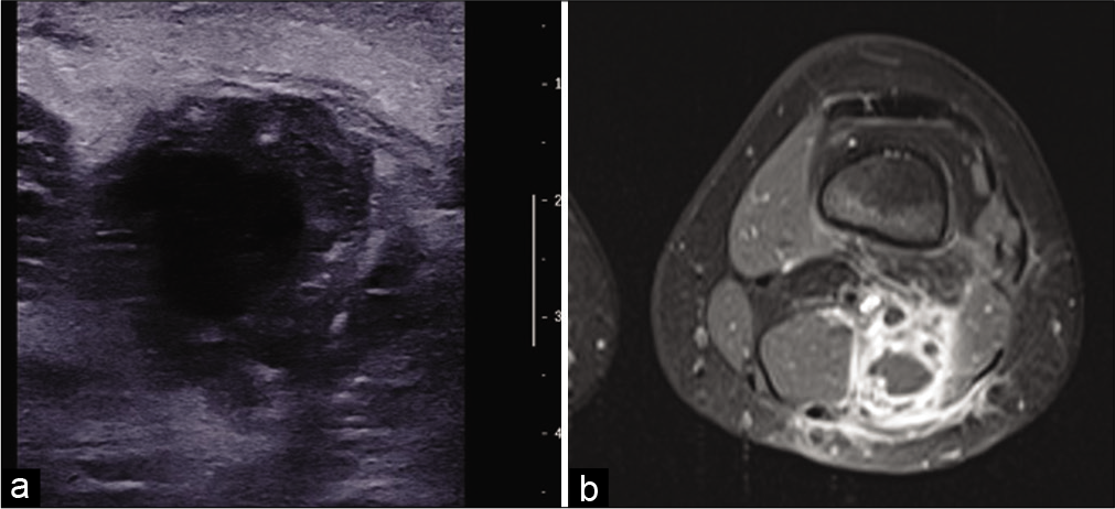 An 11-year-old girl with a popliteal fossa abscess consulting for pain and swelling with inflammatory syndrome. US: Axial ultrasound image of an abscess with hypoechoic and thick-walled, hyperechoic and heterogeneous content (a). MRI: On fat-saturated T1-weighted MRI image after injection of gadolinium chelates (b), the abscess, located between the semi-membranous and biceps muscles, has a low signal center, intense peripheral enhancement, and ill-defined peripheral enhancement due to perilesional edema.