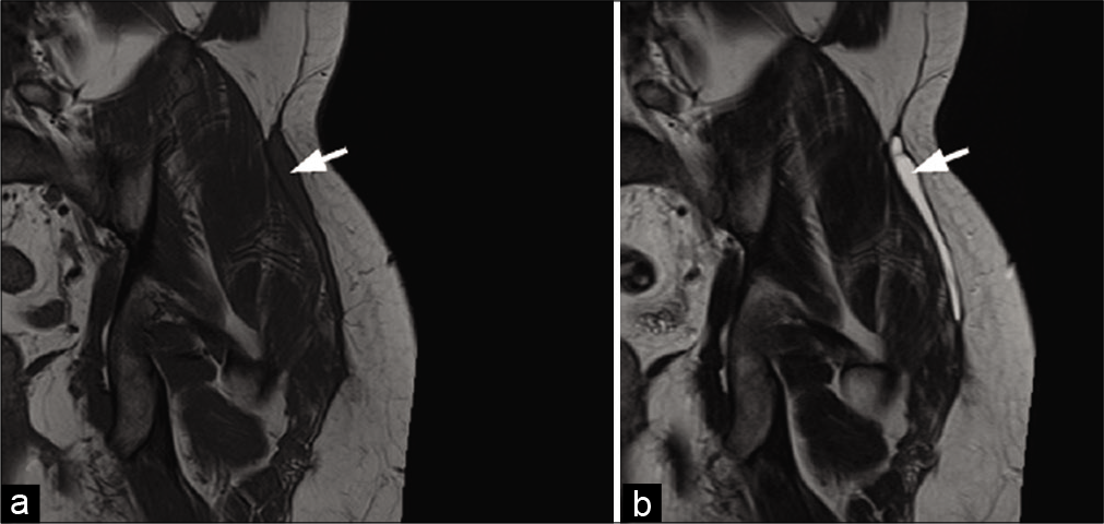 A 22-year-old man with Morel-Lavallee syndrome who presented with left hip pain 4 weeks after a motorcycle accident. MRI: Collection with a low signal on T1-weighted (a) and high signal on T2-weighted (b) coronal images, between the hypodermic fat and the peripheral deep fascia of the left gluteus maximus muscle, typical of a Morel-Lavallee syndrome (arrows).