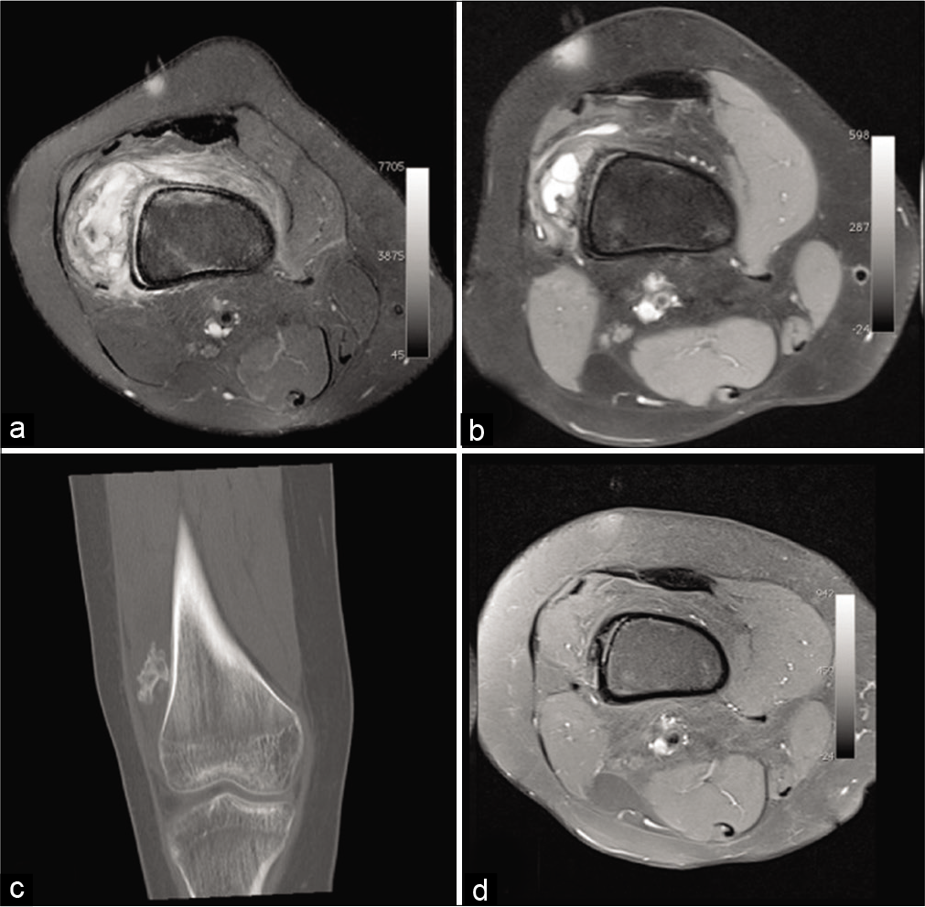 A 16-year-old girl presenting with increasing knee pain for 15 days and swelling. Natural evolution of a circumscribed myositis ossificans of the right thigh. MRI: Worrying pseudotumoral appearance on initial fat saturated proton density weighted axial MRI image (a). 7 months later on fat saturated T1-weighted axial image after injection (b), the size of the lesion and peri lesional infiltration decreased. The coronal CT reformat performed on the same day (c) shows ossification. Three years later, on fat saturated T1-weighted MRI image after injection (d), it has incorporated itself into the bone cortex.