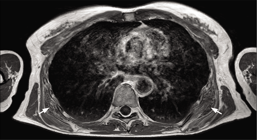 A 53-year-old woman with bilateral elastofibromas below the scapular tip, undergoing MRI for bilateral scapulalgia. Typical laminated appearance on T1-weighted axial MRI image (arrows).