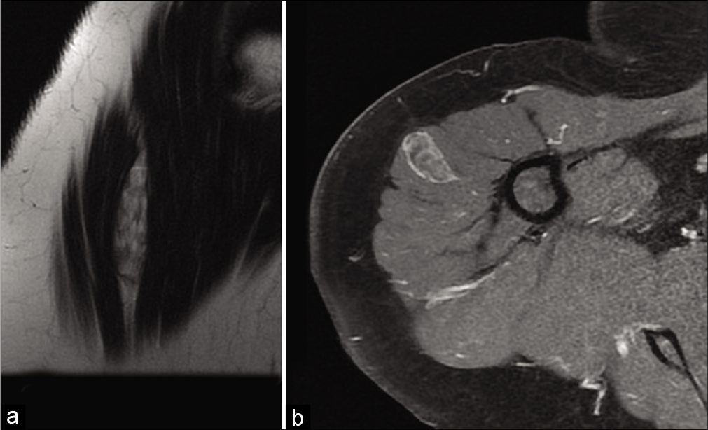 A 66-year-old woman with intramuscular myxoma who presented with palpable swelling of the right deltoid muscle. MRI: High T2-weighted signal and septa (a). It presents weak internal enhancement, with enhancement of its pseudo-capsule on fat saturated T1-weighted axial images after injection (b).