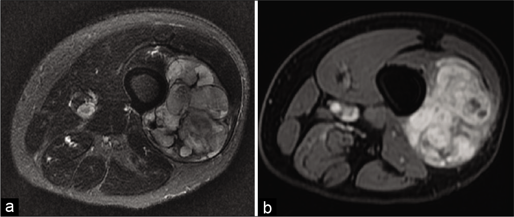 A 42-year-old man with myxofibrosarcoma consulting for a painful mass in the right thigh. MRI: On fat saturated T2-weighted axial image (a), this fibrosarcoma is very heterogeneous due to fibrous, myxoid, and tissue content, and areas of hemorrhagic necrosis. Therefore, on fat saturated T1-weighted axial image after injection (b), enhancement is also heterogeneous.