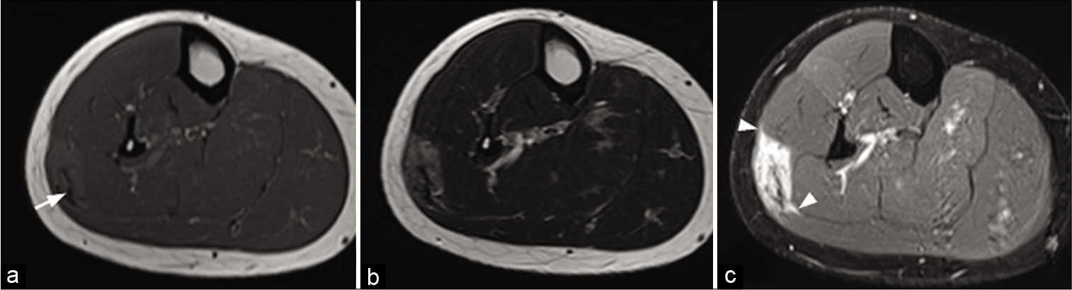 A 30-year-old woman with a desmoid tumor who presented palpable swelling of the right leg. MRI: T1-weighted axial image (a), T2-weighted axial image (b), and fat saturated T1-weighted image after injection (c) of a desmoid tumor of the superficial posterior compartment of the right leg. It presents an intermediate signal with a central fibrous area (arrow) with low signal regardless of weighting. Although non-specific, its extension along the fascia (arrowheads), clearly visible after injection (c), is suggestive of the diagnosis.