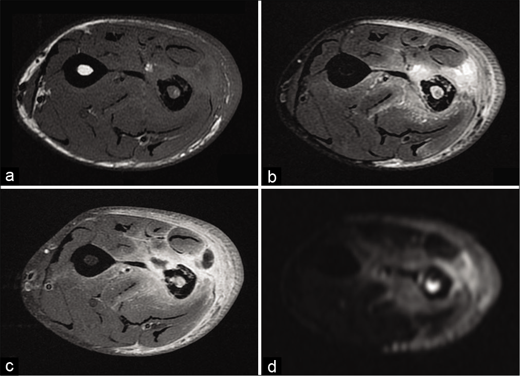 A 38-year-old man with osteitis and abscess who presented for left forearm pain without fever. T1-weighted MR image (a), fat-suppressed T2-weighted image (b), fat-suppressed T1-weighted image after injection of gadolinium chelates (c) and diffusion weighted image (d) of radial osteitis: Cortical erosion of low T1-weighted signal and high diffusion-weighted signal of the medullary. Deep muscular abscess (short radial extensor of the carpus, short extensor, and long abductor of the thumb) have low T1-weighted signal (a), high T2-weighted signal (b), peripheral enhancement (c), and high diffusion-weighted signal (d). Bacteriological analysis found Staphylococcus aureus.