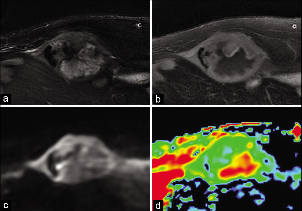 A 72-year-old man with dedifferentiated spindle cell sarcoma who presented for growing abdominal wall mass. Fat-suppressed T2-weighted MR image (a), fat-suppressed T1-weighted image after gadolinium chelate injection (b), diffusion-weighted image (c) and Apparent Diffusion Coefficient (d). Moderately high diffusion-weighted image with high ADC of the necrotic portion and low ADC of the tissue portion.