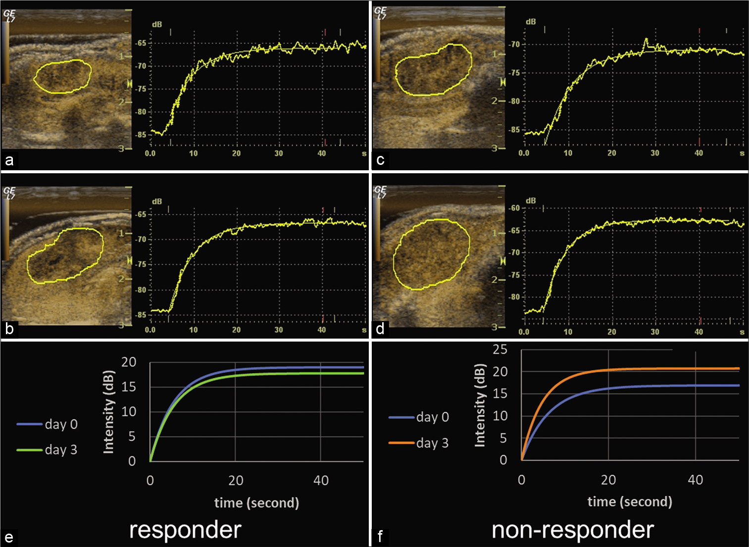 Representative responder and non-responder fitted curves. Time-intensity curves on days 0 and 3 and fitted curves after modelization at baseline for a responder (a, b, and e, respectively) and a non-responder (c, d, and f, respectively). In the responder, TTP shortened 1.2 s and PI decreased 1.2 dB. In the non-responder, TTP shortened 5.2 s and PI increased 3.9 dB. The relative change of TTP in the non-responder was shorter than in the responder. TTP: Time to peak, PI: Peak intensity.