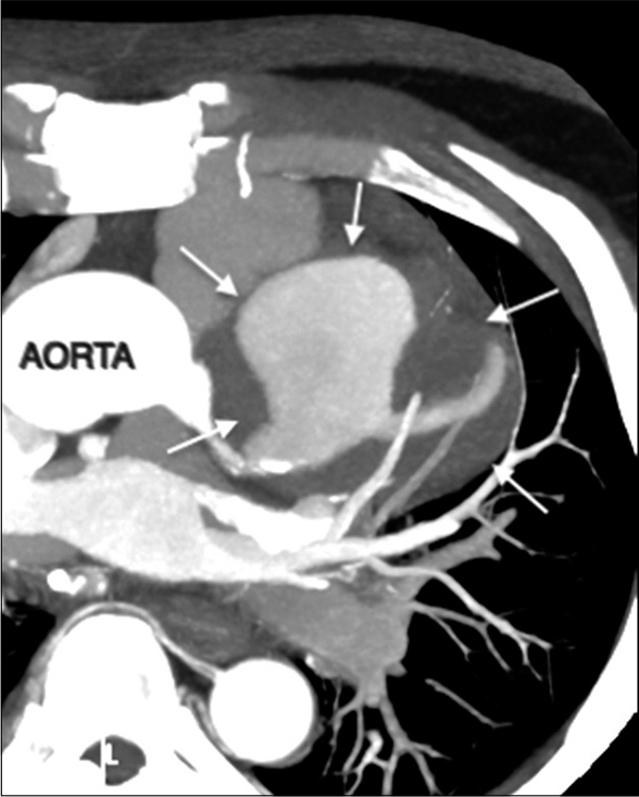 A 55-year-old male with confirmed IgG4 vasculopathy. Axial maximum intensity projection (MIP) image of CT coronary angiography shows partially thrombosed aneurysm of the left anterior descending artery (arrows).