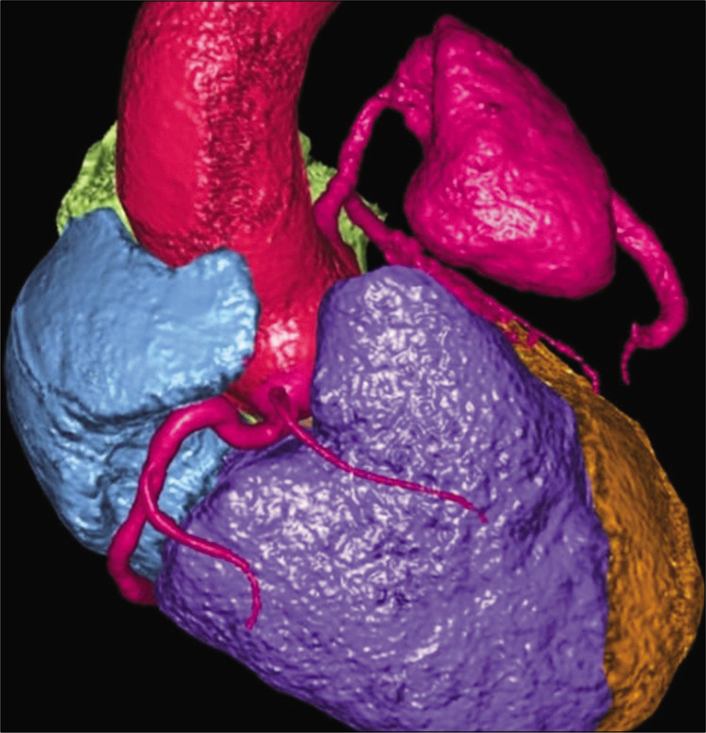 A 55-year-old male with confirmed IgG4 vasculopathy. Volume rendered image shows the aneurysm of the left anterior descending artery (in pink).