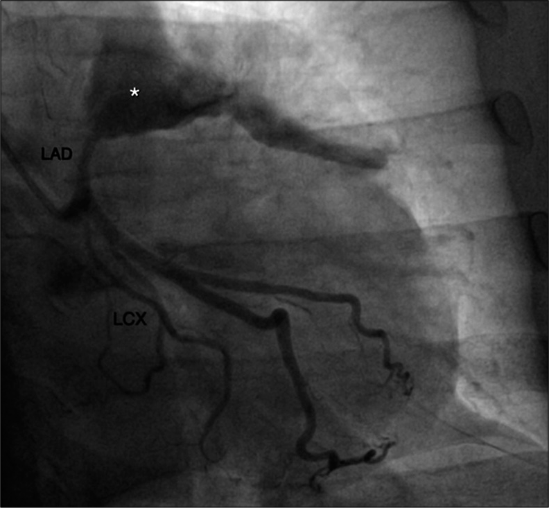 A 55-year-old male with confirmed IgG4 vasculopathy. The right anterior oblique caudal view of conventional angiography shows aneurysmal dilatation of the left anterior descending artery with contrast blush (*).