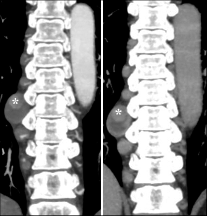 A 55-year-old male with confirmed IgG4 vasculopathy. Coronal maximum intensity projection images of CT abdominal angiography in arterial (left) and venous (right) phases show partially thrombosed aneurysm in the proximal part of 8th right intercostal artery (*). Enhancing nodular paravertebral soft-tissue thickening is noted adjacent to the proximal right intercostal arteries above and below this level.