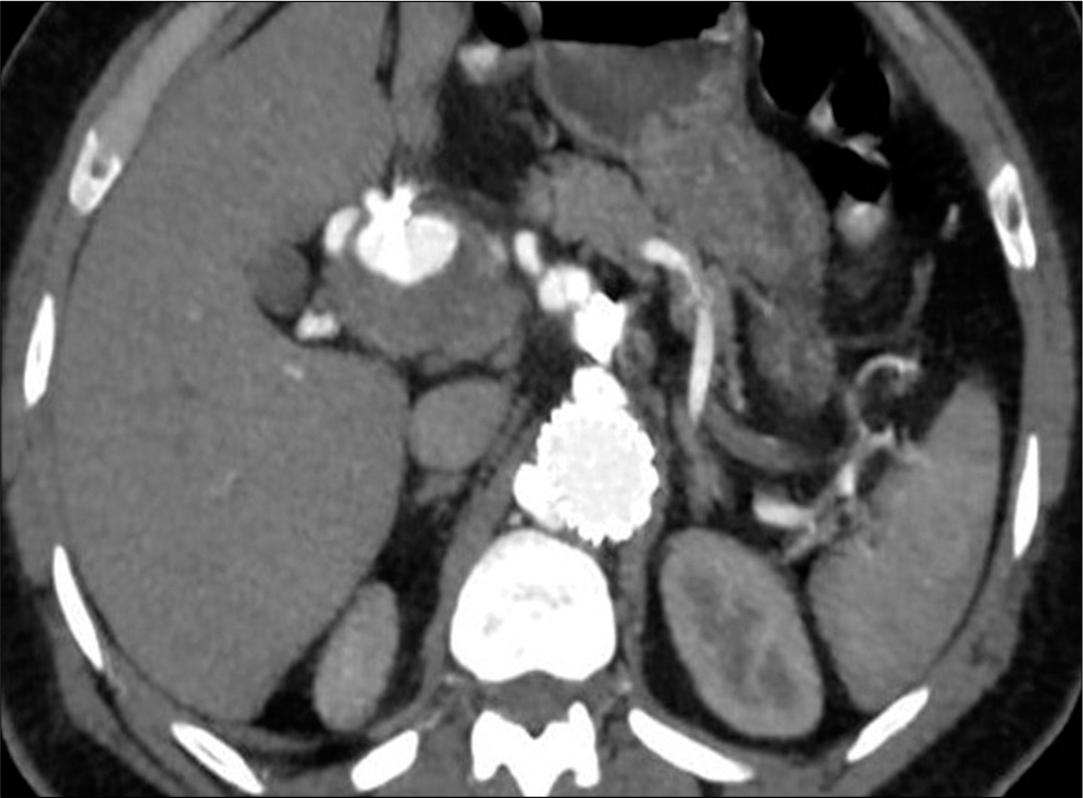A 55-year-old male with confirmed IgG4 vasculopathy. Axial image of CT abdominal angiography in the arterial phase shows a partially thrombosed aneurysm in relation to the common hepatic artery. Artifacts are seen in relation to the aneurysm (post-injection in the gastroduodenal artery). The aortic stent graft is also seen in situ.