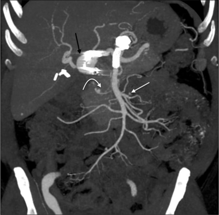 A 55-year-old male with confirmed IgG4 vasculopathy. Coronal maximum intensity projection image of CT abdominal angiography shows multiple visceral artery aneurysms – in relation to the common hepatic artery (black arrow), inferior pancreaticoduodenal artery (white curved arrow), and the jejunal branch of superior mesenteric artery (white arrow). Artifacts are noted in relation to the gastroduodenal artery, aorta, and the superior mesenteric artery – representing stent grafts and post-procedural changes. Cholecystectomy clips are also seen.