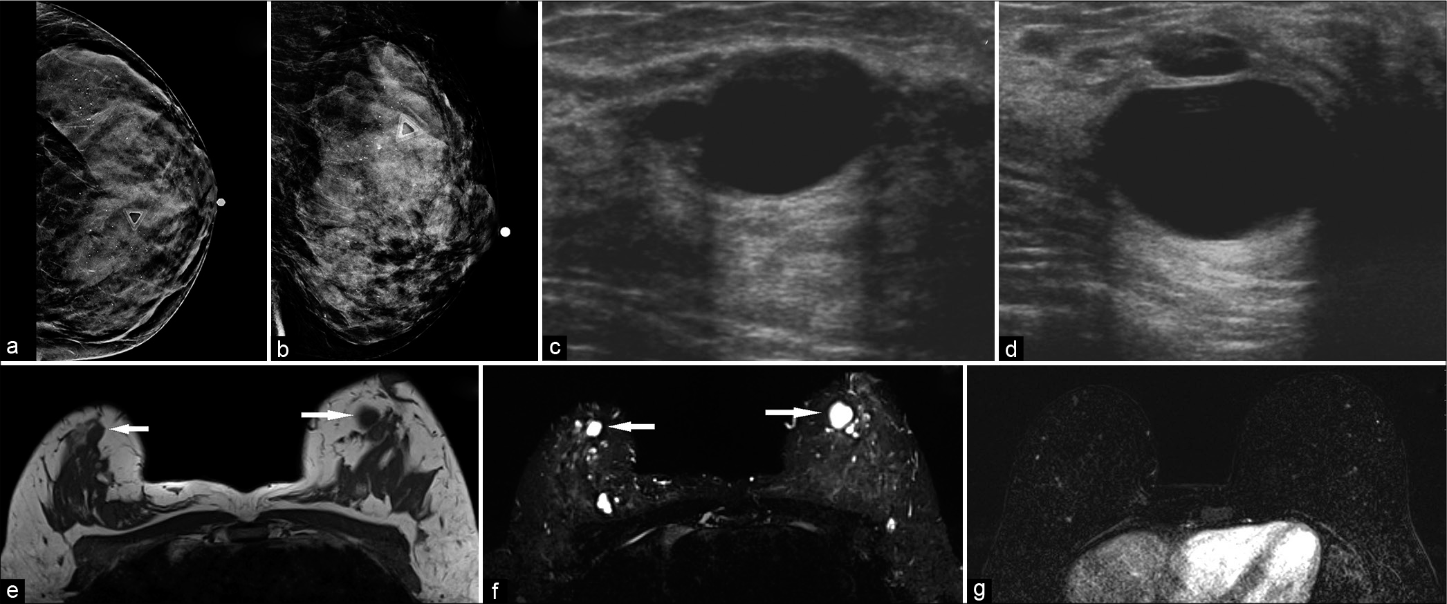 A 42-year-old female at high risk for breast cancer (multiple family members with breast cancer), presented with palpable lump in the left breast. Diagnostic mammogram CC (a) and MLO (b) views demonstrated extremely dense breasts with indeterminate calcifications. No definite abnormality could be identified underneath the palpable lump marker. The left breast ultrasound transverse (c) and sagittal (d) views demonstrated a 2.6 × 1.6 × 2.8 cm (AP × TR × CC) anechoic mass, with thin imperceptible walls and posterior acoustic enhancement, consistent with cyst, corresponding to the area of palpable lump in the left breast, at 11:30 position, 2 cm from the nipple. Magnetic resonance imaging both breasts demonstrated T1 hypointense (e) and T2 hyperintense (f) well-circumscribed round or oval masses in both breasts (white arrows) which did not show any post-contrast enhancement (g). The palpable lump in the left breast, 2 cm from the nipple, also corresponded to a cyst.