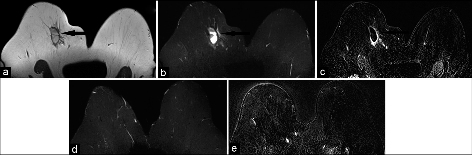 A 65-year-old female who was status post right breast lumpectomy for invasive ductal carcinoma at 12’o position, 9 cm from the nipple, presented for follow-up imaging. Magnetic resonance imaging (MRI) breasts demonstrated T1 hypointense (a), T2 hyperintense (b) mass measuring 4.2 × 1.9 × 2.5 cm (AP × TR × CC) in the upper slightly inner right breast (black arrow), 10.5 cm from the nipple. Dynamic contrast-enhanced MRI (c) demonstrated rim enhancement of the mass (black arrow), consistent with post-surgical hematoma/ seroma. In addition, mild non-mass-like enhancement was noted adjacent to the collection. After 6 months, follow-up MRI-T2 (d) and contrast-enhanced (e) images showed resolution of the mass, confirming prior diagnosis of post-surgical hematoma/seroma.