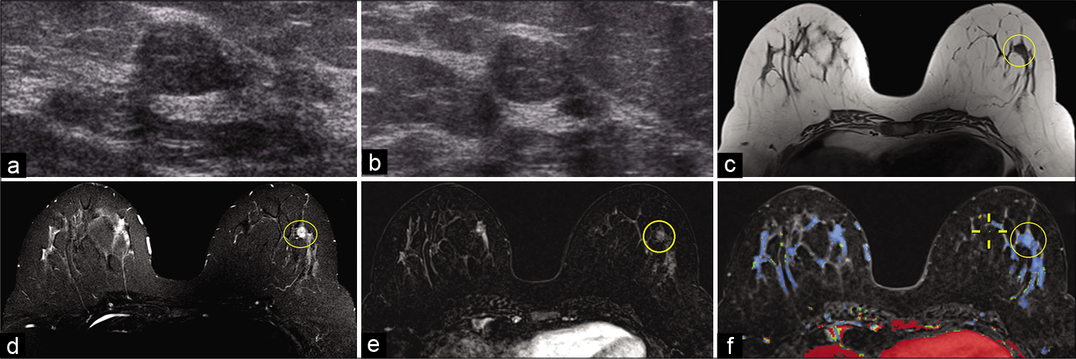 A 37-year-old female presented for a palpable right breast mass. Targeted ultrasound – transverse (a) and sagittal (b) images of the left breast demonstrated an oval hypoechoic circumscribed mass, approximately 1 cm in greatest dimension, at 5’o position, 4–5 cm from the nipple. No mammographic correlate was identified. Magnetic resonance imaging (MRI) breasts demonstrated a 0.8 cm well-circumscribed T1 hypointense (c), T2 hyperintense (d) mass in the lower outer quadrant of the left breast (yellow circle), approximately 4.5 cm from the nipple. The mass showed thin internal septations on T2W imaging. Dynamic contrast-enhanced MRI (e) demonstrated homogeneous enhancement within the mass (yellow circle) with persistent kinetics (f). Ultrasound-guided biopsy revealed fibroadenoma.