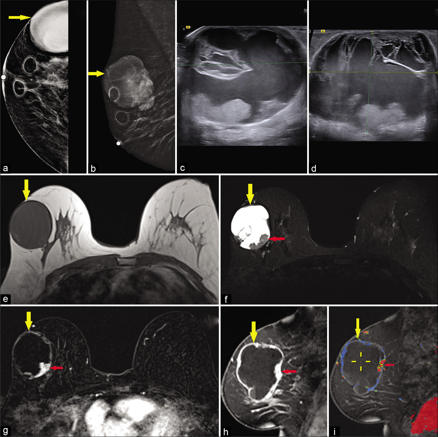 A 65-year-old female presented for a palpable left breast lump. Diagnostic mammogram CC (a) and MLO (b) views demonstrated a large high-density mass in the upper outer right breast (yellow arrow). Targeted ultrasound – transverse (c) and sagittal (d) images of the left breast demonstrated a mixed cystic and solid mass measuring approximately 4.4 × 5.7 × 5.2 cm (AP × TR × CC) at 10’o position, 7 cm from the nipple. Magnetic resonance imaging (MRI) breasts demonstrated T1 hypointense (e), T2 hyperintense (f) large cystic and solid round mass in the upper outer right breast (yellow arrow) with mural nodularity (red arrow) and fluid-fluid levels. Dynamic contrast-enhanced MRI axial (g) and sagittal images (h) demonstrated peripheral and nodular mural enhancement (red arrow) in the mass (yellow arrow), with washout kinetics in the mural nodule (i), ultrasound-guided core biopsy of the mass showed papillary carcinoma.