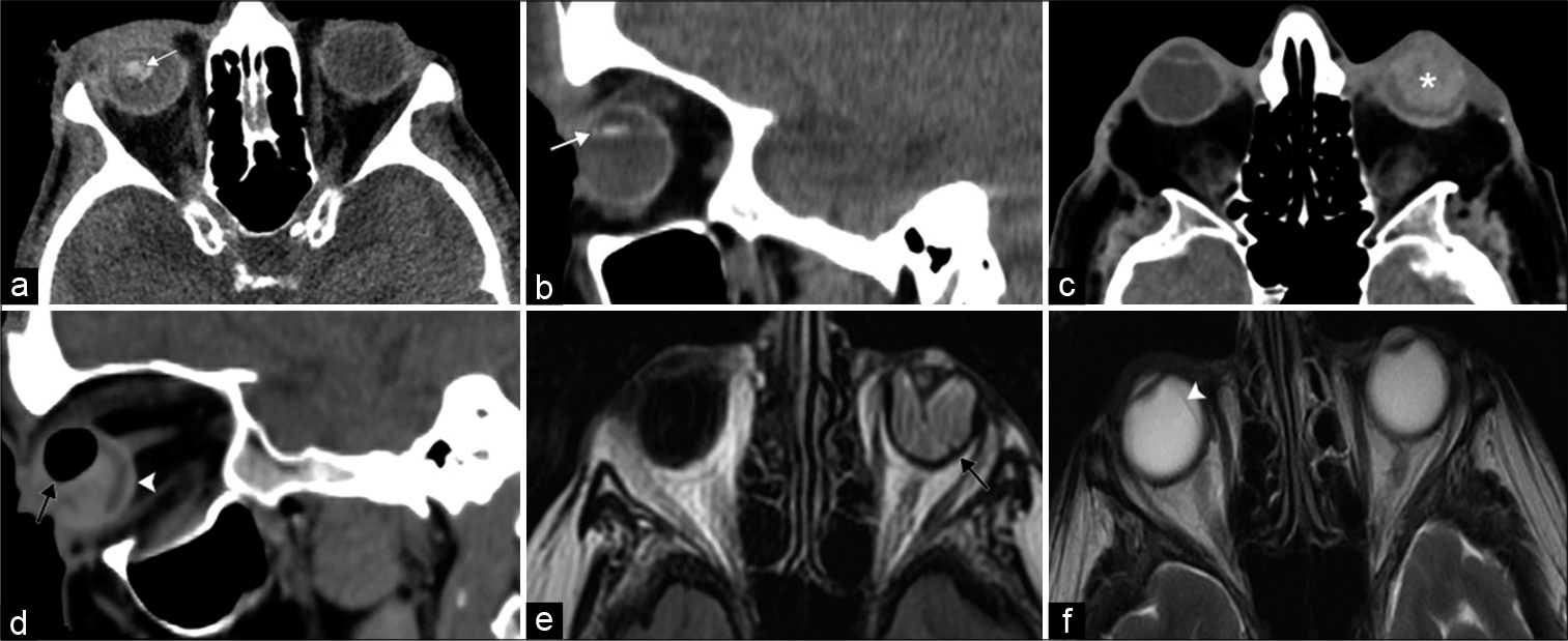 Vision loss at the level of the globe. A 45-year-old patient presents after direct trauma to the right eye with acute monocular right vision loss. (a and b) Axial and sagittal computed tomography (CT) images, respectively, demonstrate right ocular lens dislocation posteriorly and inferiorly (white arrows). A 92-year-old patient presents after direct trauma to the left eye with acute monocular left vision loss. (c and d) Axial and sagittal CT images, respectively, illustrate features of globe rupture including intraocular hemorrhage (asterisk), air (black arrow), and thickened posterior sclera (white arrowhead). (e) Axial T2/Fluid attenuated inversion recovery MR image shows left retinal detachment with folded membranes in the subretinal space (black arrow). (f) Axial T2-weighted MR image displays choroidal detachment in the right eye (white arrowhead).