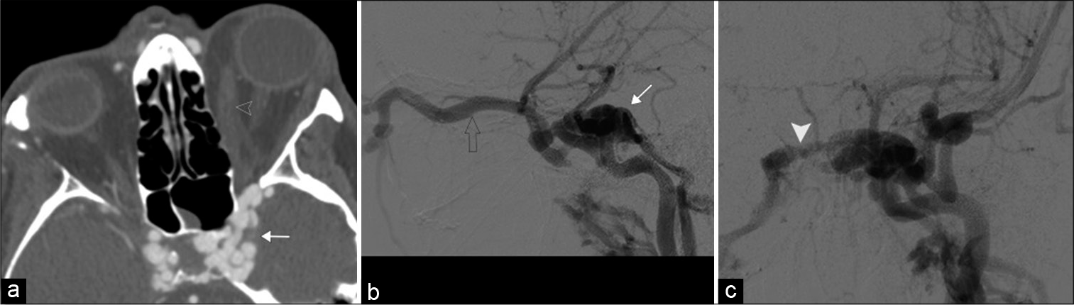 Carotid-cavernous fistula. A 52-year-old female with a history of trauma presents with left globe proptosis. (a) Axial contrast-enhanced computed tomography angiogram, (b and c) lateral and frontal DSA images, respectively, demonstrate a markedly enlarged left cavernous sinus with multiple serpiginous vessels (white arrow) draining a dilated left superior ophthalmic vein (open arrowhead) and intercavernous sinus (white arrowhead). Note the right cavernous sinus is also more full than normal.