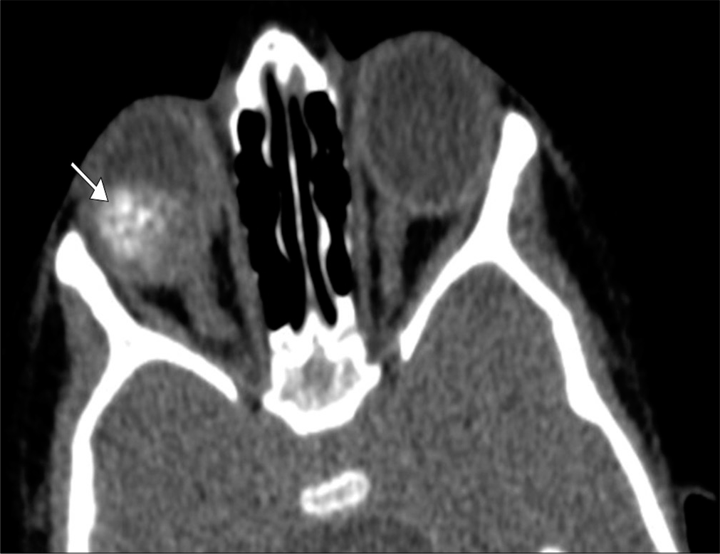 Retinoblastoma. A 3-year-old boy presents with leukocoria of the right eye. Axial computed tomography image demonstrates a coarsely calcified intraocular mass in the right eye (arrow). Tumor bulk is predominantly central which is characteristic of the endophytic pattern.