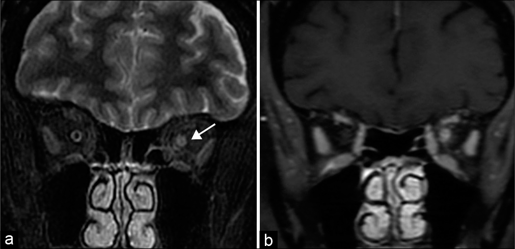 Optic neuritis. A 56-year-old woman presents with left eye pain and blurry vision and papilledema. (a) Coronal STIR MR image demonstrates increased signal within the left optic nerve, consistent with edema (arrow). (b) Coronal T1 post-contrast MR image shows corresponding enhancement.