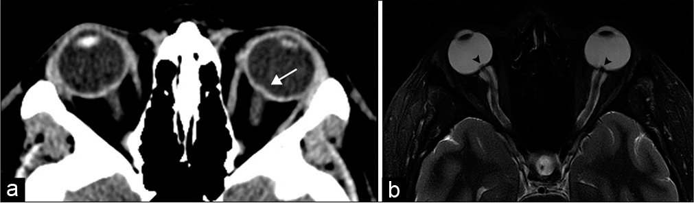 Idiopathic intracranial hypertension. A 20-year-old woman presents with headaches and papilledema. (a) Axial computed tomography image demonstrates stigmata of intracranial hypertension with subtle intraocular protrusion of the optic heads, more prominent on the left (arrow). (b) Axial T2-weighted MR image more clearly shows intraocular optic head protrusion (arrowheads) with associated prominent perioptic subarachnoid space.